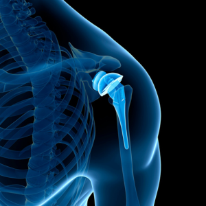 image showing shoulder replacement on an x-ray